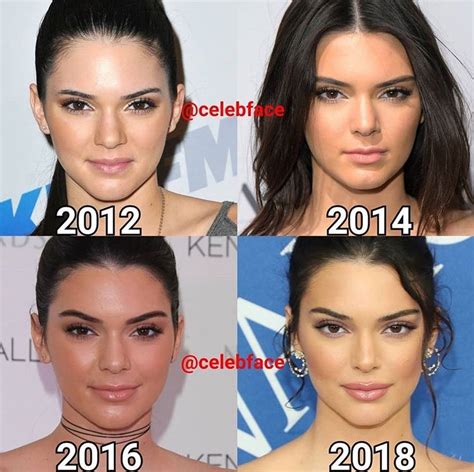 Pin By Dayan On Plastic Surgery Kendall Jenner Plastic Surgery