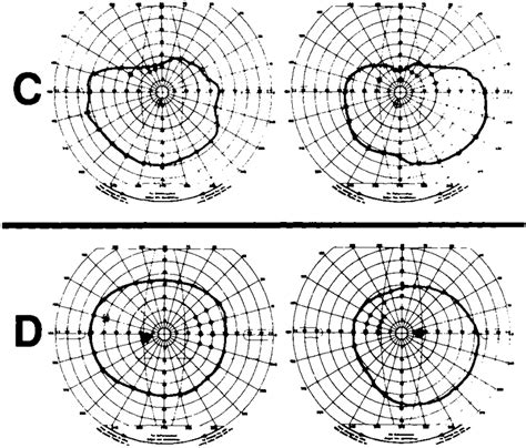 Visual Fields Of Patients C And D All Fields Show Kinetic Isopter To