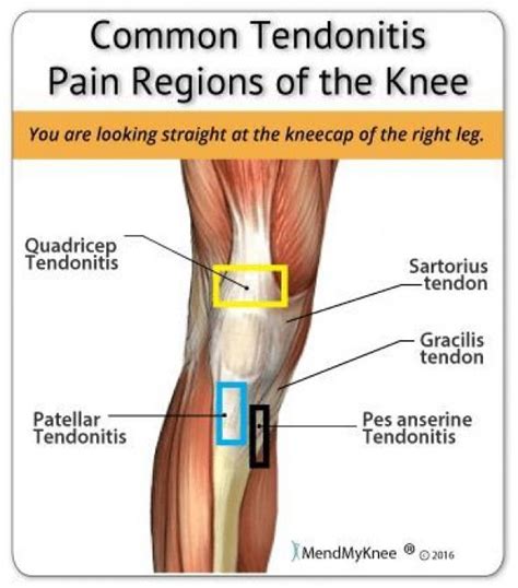 Knee Tendonitis Anatomy Common Areas Of The Knee That Are Afflicted