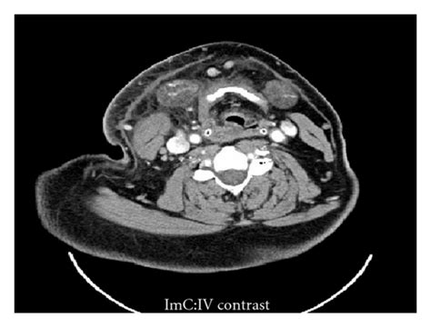 Axial Contrast Enhanced Ct Scan Of The Patient In Figure 1 Showing