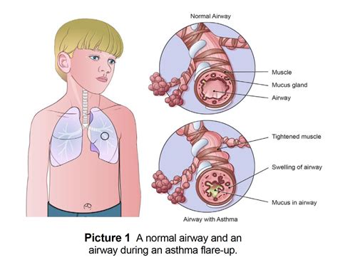 Is Reactive Airway Disease Asthma KnowYourAsthma Com