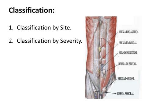 Ppt Abdominal Hernias Powerpoint Presentation Free Download Id2079232