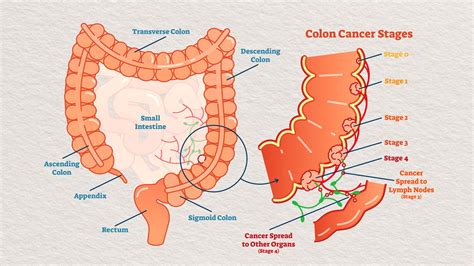 Hen Period Reference Colon Cancer Lymph Nodes Debtor Cold Treason