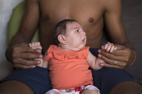 Its Official Zika Virus Causes Birth Defects Nbc News