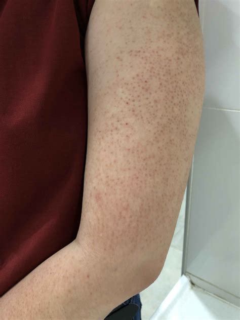 Can Severe Keratosis Pilaris Scars Be Completely Removed By Laser