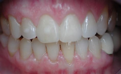 How to fix a teeth gap without braces, dental crown and bridge. Invisalign › Killian Hill Dental Care - Lilburn, GA