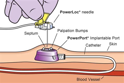 Portacath Insertion Hagley Vascular Dr Daniel Hagley