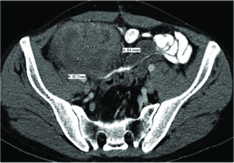 Contrast Enhanced Computed Tomography Cect Of The Abdomen A Complex