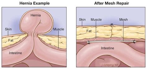 Hernia Mesh Repair