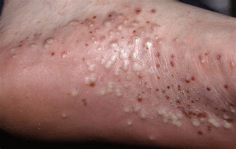 Pictures Of Psoriasis Page 5 Psoriasis Expert