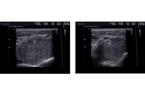 Vietnamese Medic Ultrasound Case 183 Left Arm Mass Dr Phan Thanh HẢi