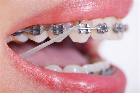 Orthodontic Patient Compliance Uk Adult Braces