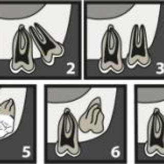 The classification was determined according to the winter, pell, and gregory classification. Pell & Gregory's classification for lower third molars ...