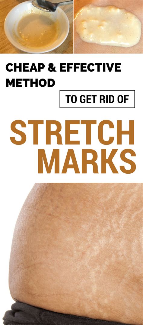Check How To Remove The Stretch Marks Completely Stretch Marks