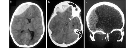 Ct Scan Showing A Right Frontal Extradural Hematoma With Mass Effect On