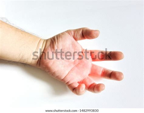 Hand Fingers Tendinitis Office Syndrome Danger Stock Photo 1482993830