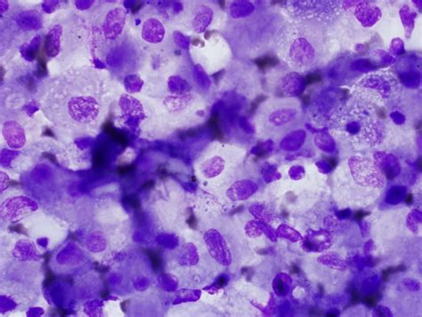 Histoplasmosis Induced Hemophagocytic Syndrome A Case Series And