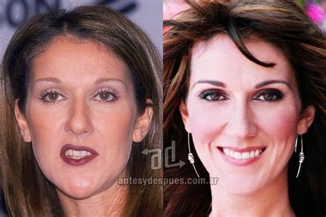 Celine Dion Plastic Surgery Photos Before After