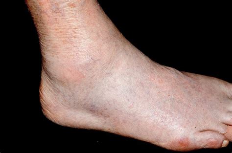Gout In The Ankle Photograph By Dr P Marazziscience Photo Library