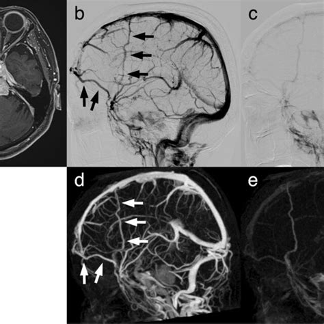 Representative Case Of The Late Type Diploic Vein Contrast Enhanced