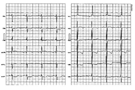 Preoperative Electrocardiogram Sinus Rhythm Heart Rate 60 Bpm P Wave