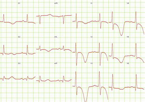 Abnormal T Wave Inversion Deep T Wave Inversion Thoracic Key An
