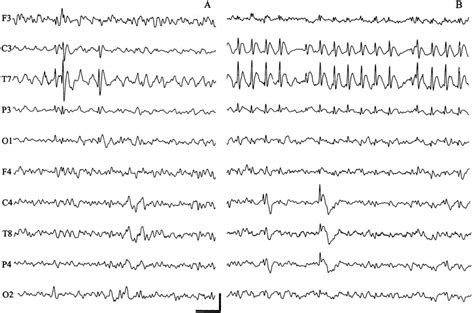 Interictal Patterns Specific For Complicated Benign Epilepsy With
