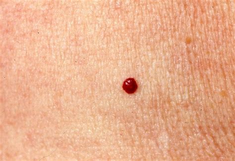 Cherry Angioma Definition Causes And Home Remedies Home Remedies