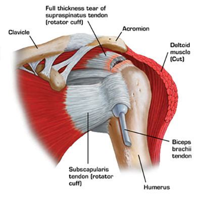 The shoulder muscles are associated with movements of the upper limb. NYC Shoulder Injuries Treatment Doctor Specialist · Sports ...