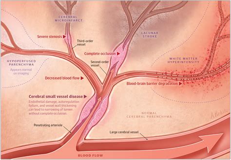 Advances In Understanding The Pathophysiology Of Lacunar Stroke A Review Cerebrovascular