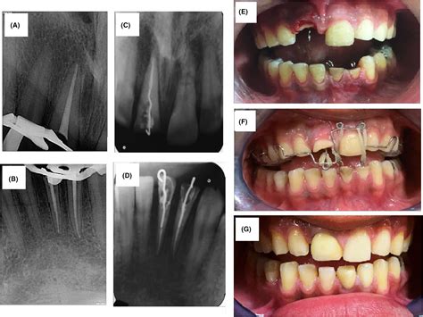 Management Of A Complex Traumatic Dental Injury Crown Crown‐root And Root Fracture Sanaei
