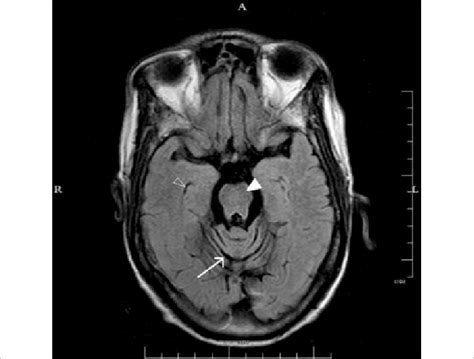 Case 1 Axial View Of Brain Mri Flair Image Showing Marked Atrophy Of