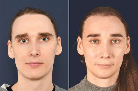 Transgender Genital Surgery Before And After