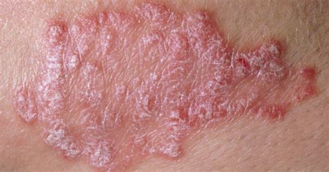 Psoriasis Vs Lupus Similarities And Differences