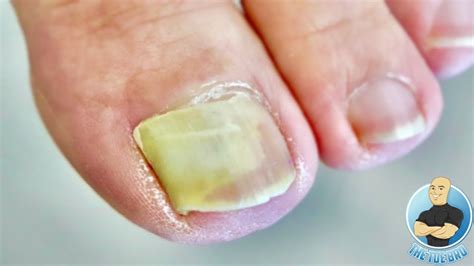 Damaged Big Toenail Completely Lifted How To Treat Lifted Toenails