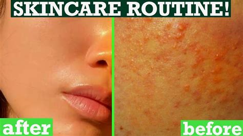 How To Get Rid Of Tiny Bumps On Face Skin Texture Acne Clear Skin