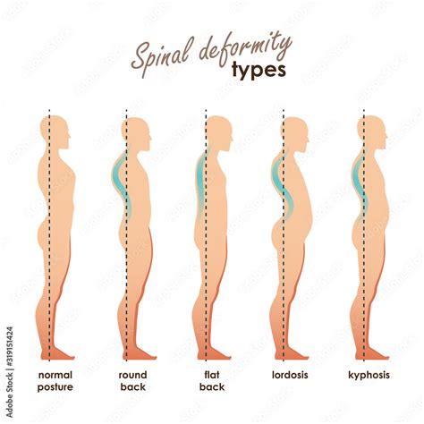 Spinal Deformity Types Diseases Of The Spinelordosis Kyphosis Round
