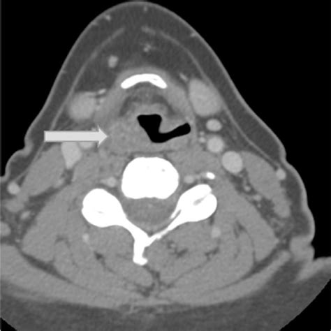 Axial Image From Contrast Enhanced Ct Scan Of The Neck Demonstrates