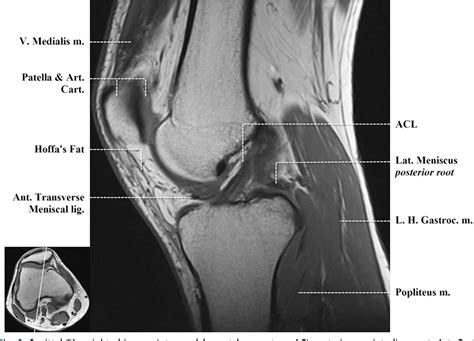 This webpage presents the anatomical structures found on knee mri. Figure 14 from Normal MR imaging anatomy of the knee ...