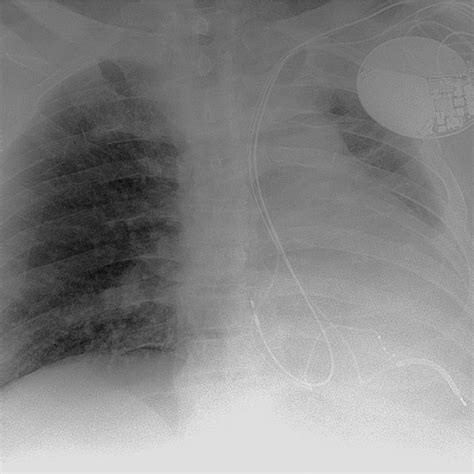Chest X Ray Immediately After Implantation Of A Cardiac Download