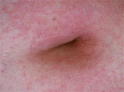 Belly Button Rash Hot Sex Picture