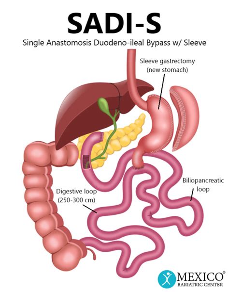 Single Anastamosis Duodenal Switch Mexico Bariatric Center