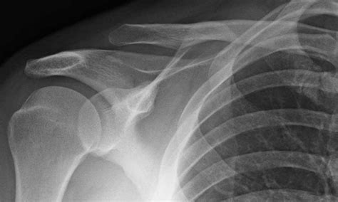 What Is An Ac Joint Separation Or A Shoulder Separation Brent J