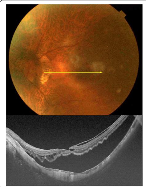 Fundus Photograph And Swept Source Optical Coherence Tomographic