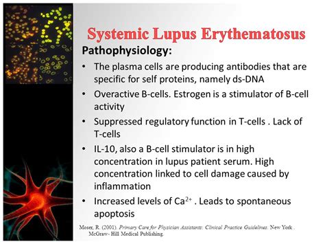 Systemic Lupus Erythematosus Pathophysiology Ppt Warm Wendell