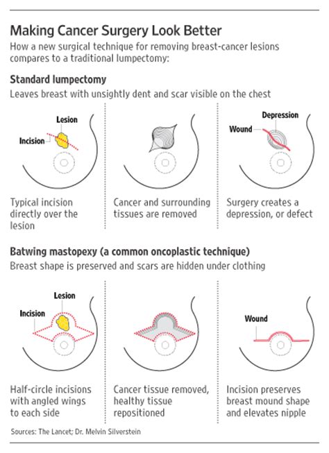 New Surgery Eases The Toll Of Breast Cancer Wsj