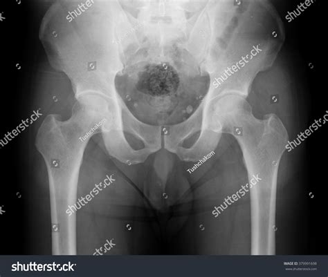 Xray Pelvis Spinal Column Woman Stock Photo 379991698 Shutterstock