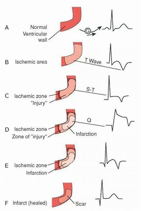 Myocardial infarction (heart attack, mi) nursing management interventions, medications nclex part 2. Myocardial infarction on Pinterest