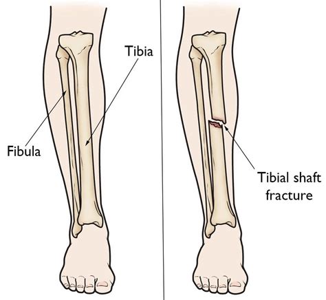 Tibial Shaft Fracture Causes Types Symptoms Diagnosis Treatment
