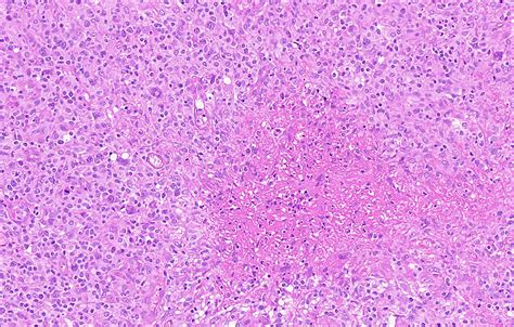 Pathology Outlines Chl Mixed Cellularity